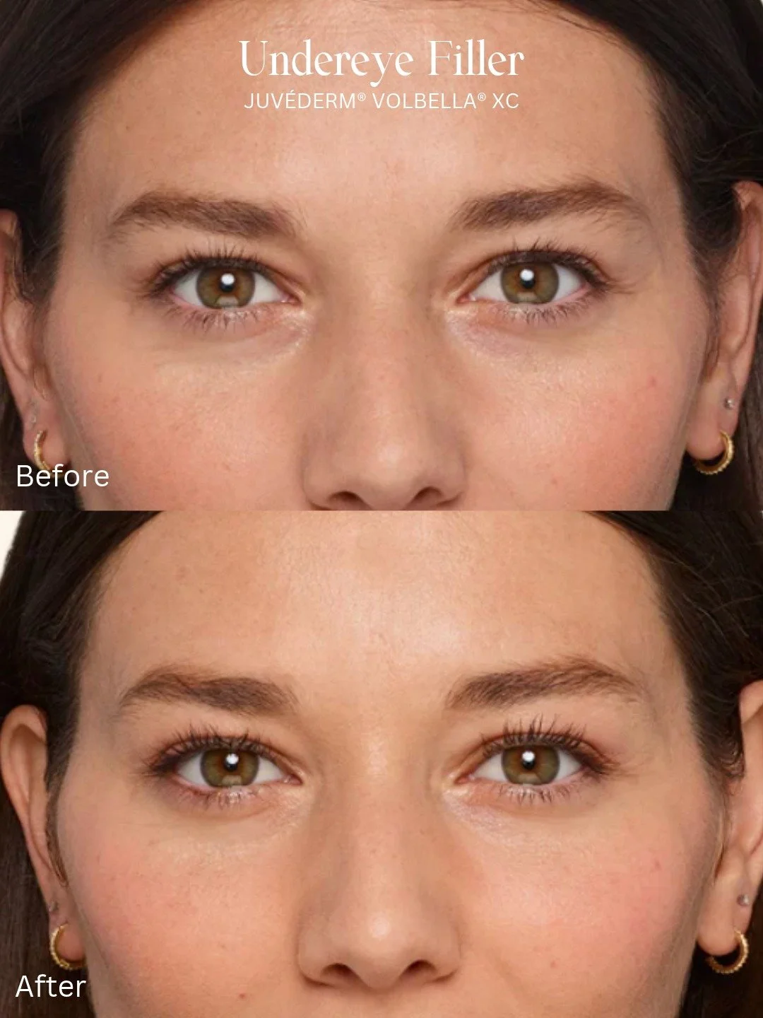 A little refresh, without looking refreshed ✨

JUV&Eacute;DERM&reg; VOLBELLA&reg; XC can help improve the appearance of undereye hollows for a smoother, more rested look.

*Results may vary.*

Book Your Consultation Online Today ↴
📍 Waynesville, NC
