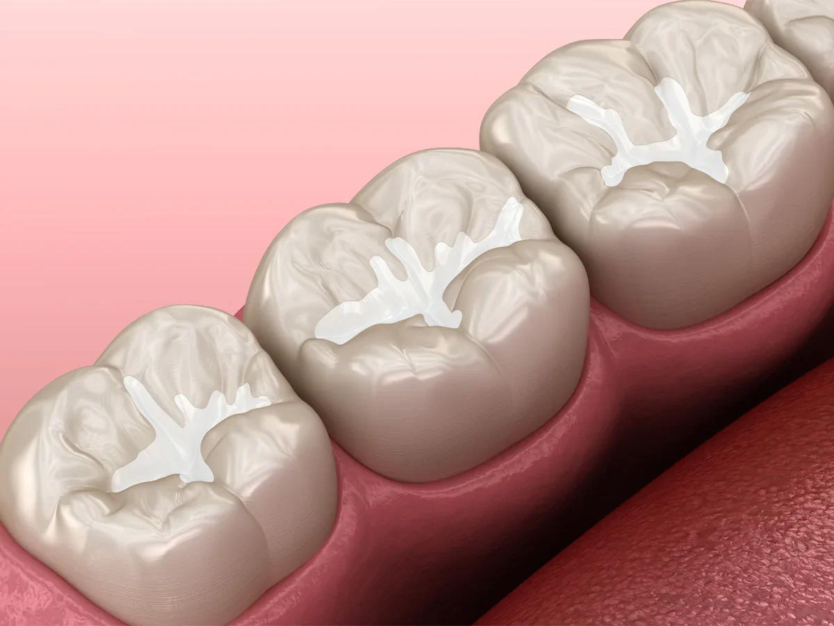 Close-up illustration of three molar teeth.