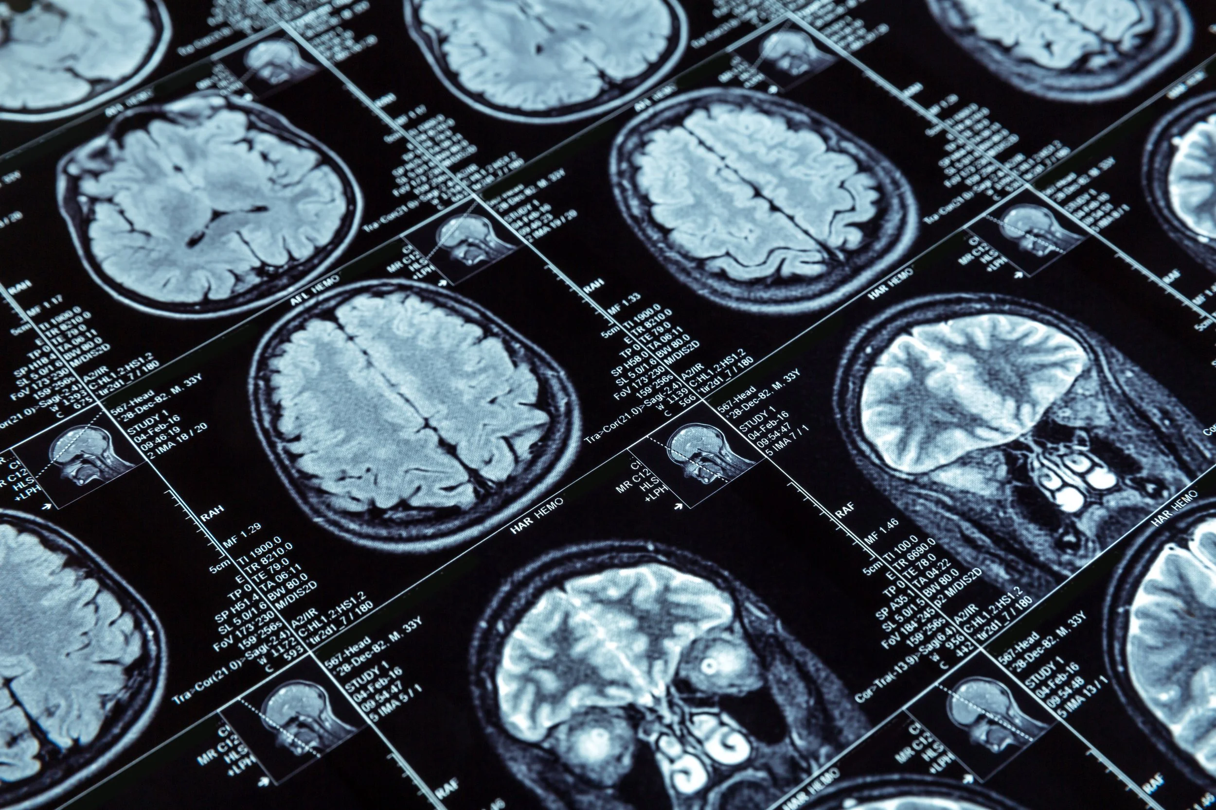 Several brain MRI scans displayed on a computer screen, showing axial views of the brain in shades of gray and white.