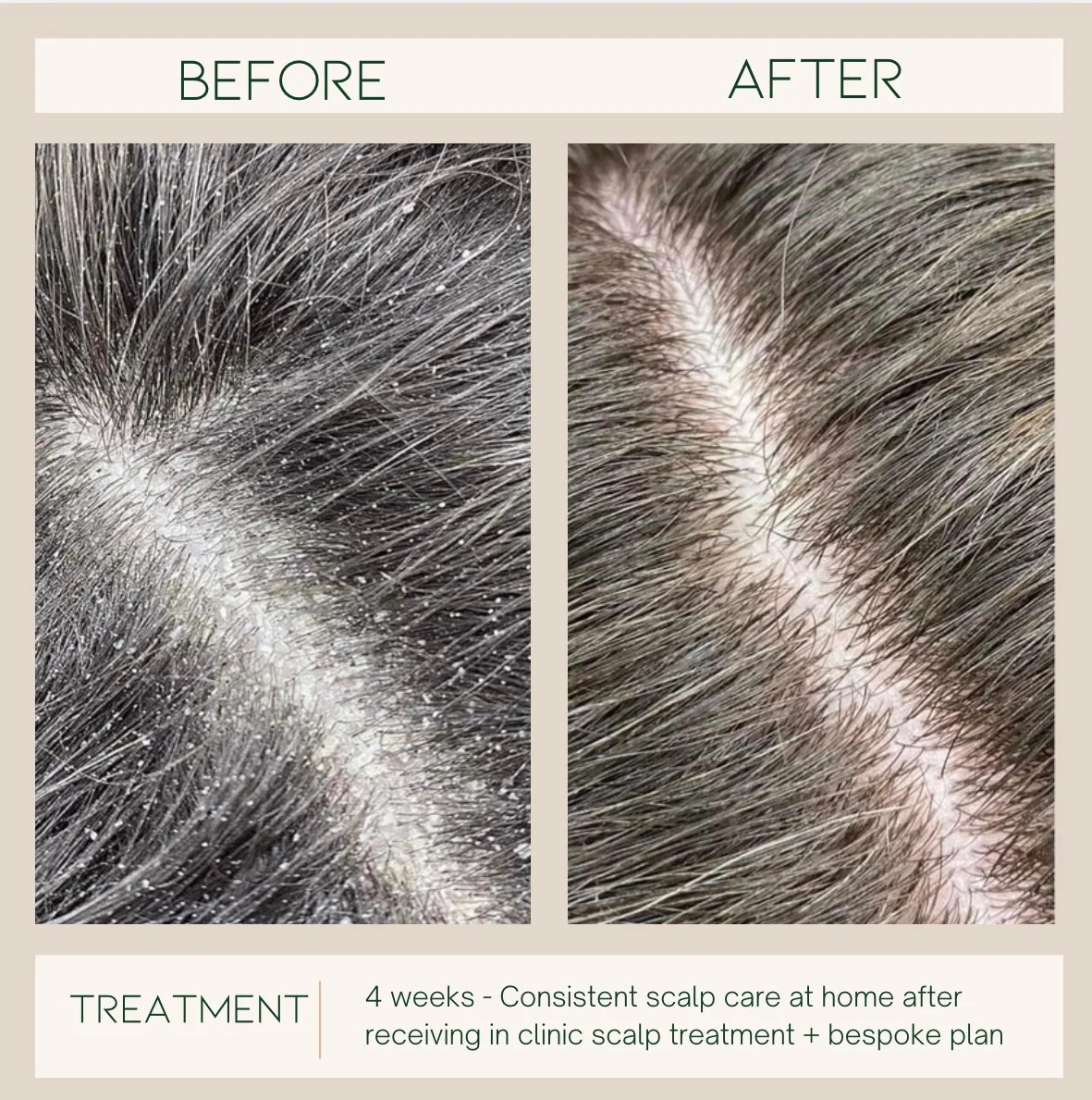 Comparison of scalp before and after treatment showing reduced dandruff and healthier scalp after 4 weeks of consistent care. How to understand scalp health.
