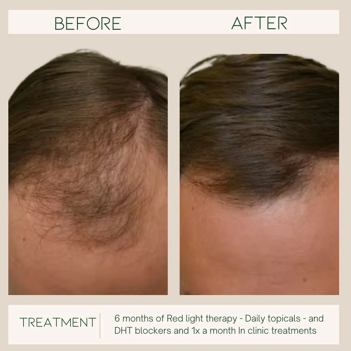 Comparison of a person's scalp before and after 6 months of treatment with red light therapy, daily topicals, DHT blockers, and monthly clinic treatments, showing increased hair density and thickness. Hair loss education