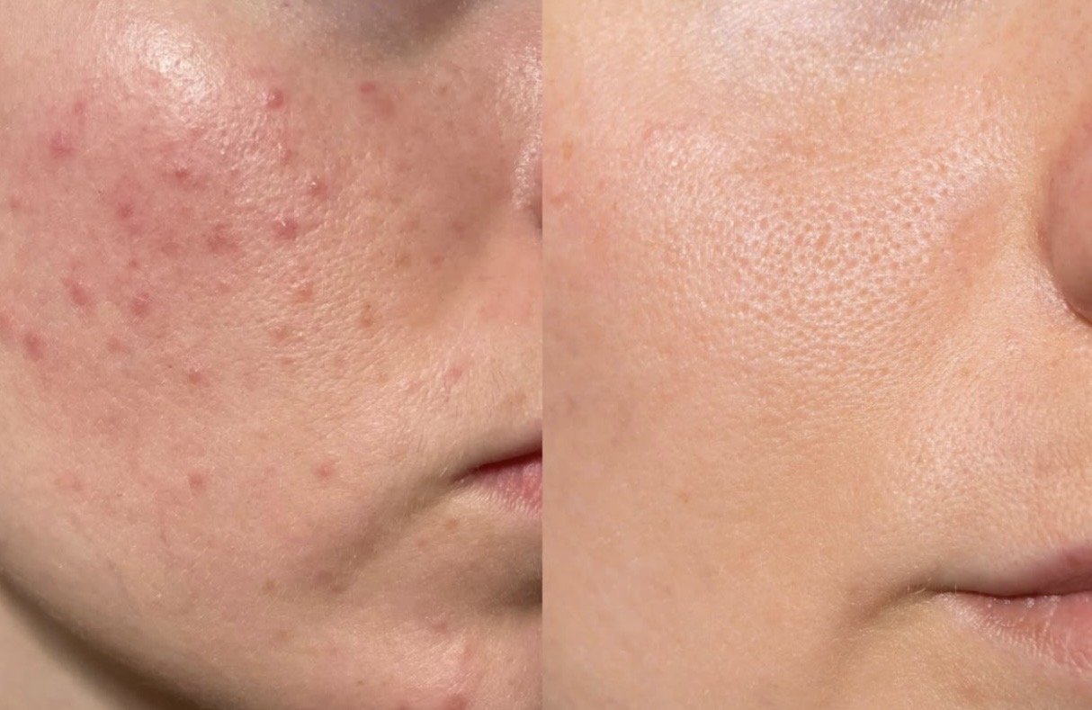 Acne Bootcamp Consultation + Treatment