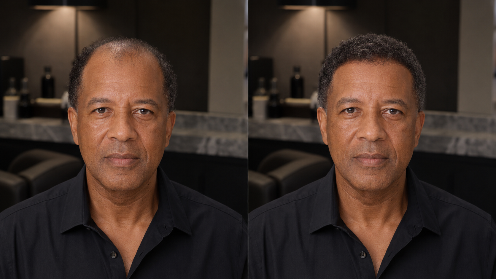 Close-up of realistic men’s hairline restoration result