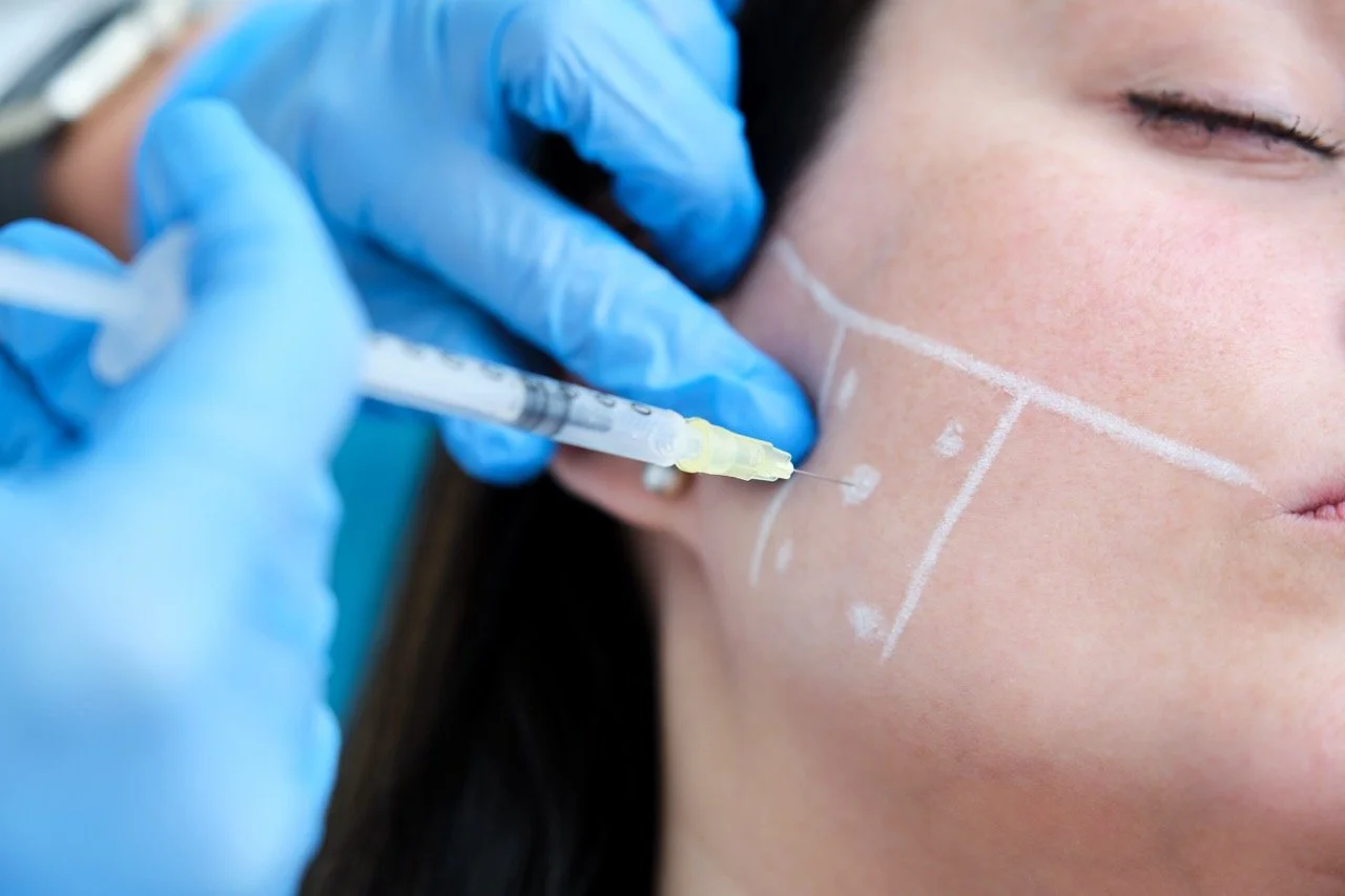 A person receiving a cosmetic injection in the cheek area with white markings on the skin to guide the procedure, while a medical professional wears blue gloves and prepares the syringe.