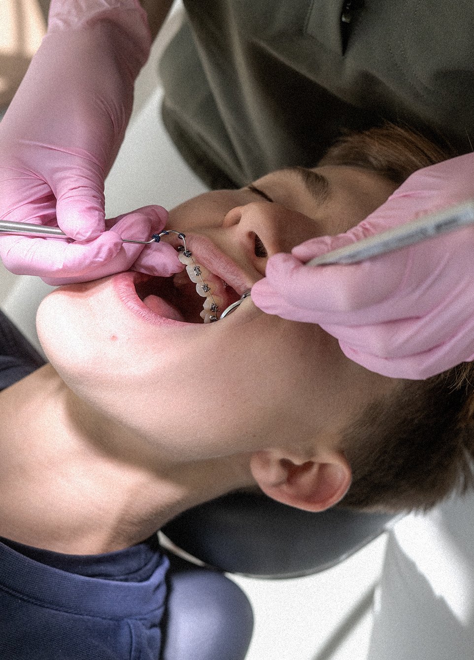 Persoon krijgt een beugel in de mond geplaatst door een tandarts met roze handschoenen.