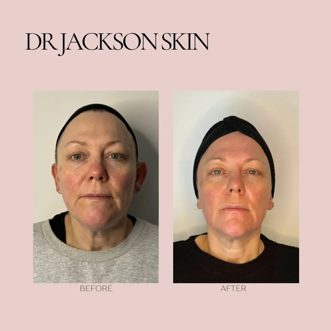 6 weeks in &amp; already a noticeable improvement in skin health, tone and texture 🤌🏼

This patient&rsquo;s main concerns were rosacea, pigmentation &amp; signs of ageing. From the outset, the focus has been on one principle: calming inflammation a