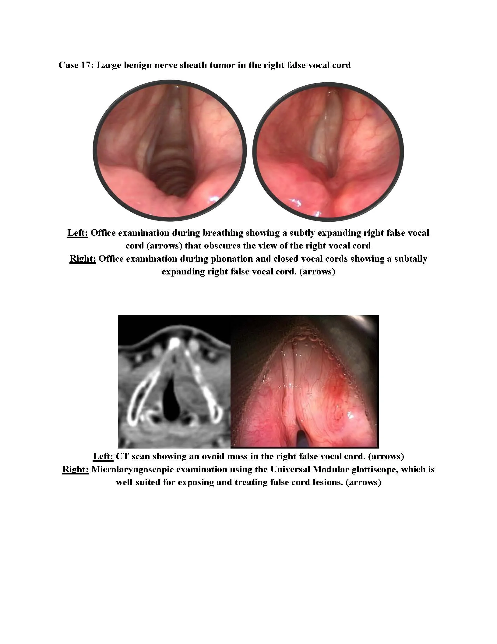 Benign Nerve Sheath Tumor of the Right False Vocal Cord