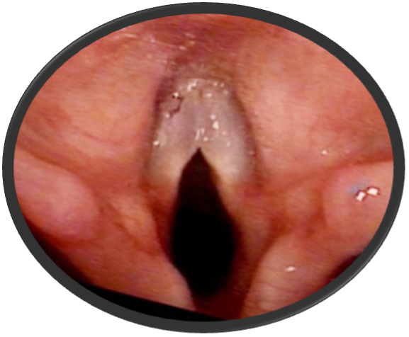 Glottic Diastasis