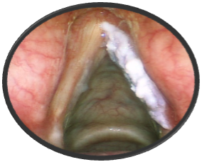 Verrucous Keratosis with Precancerous Dysplasia of the Vocal Cords