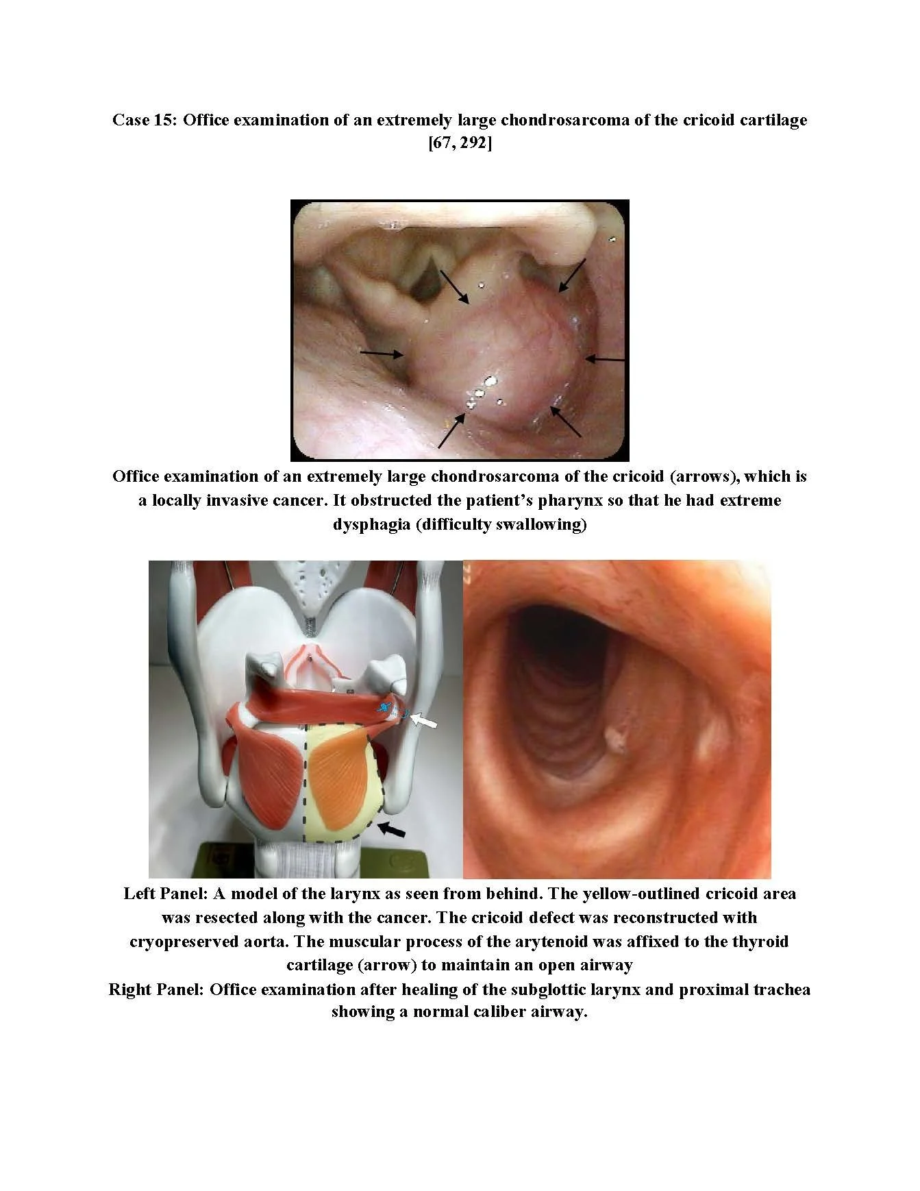 Laryngeal Chondrosarcoma Treatment