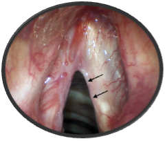 Carcinoma In Situ of the Vocal Cord