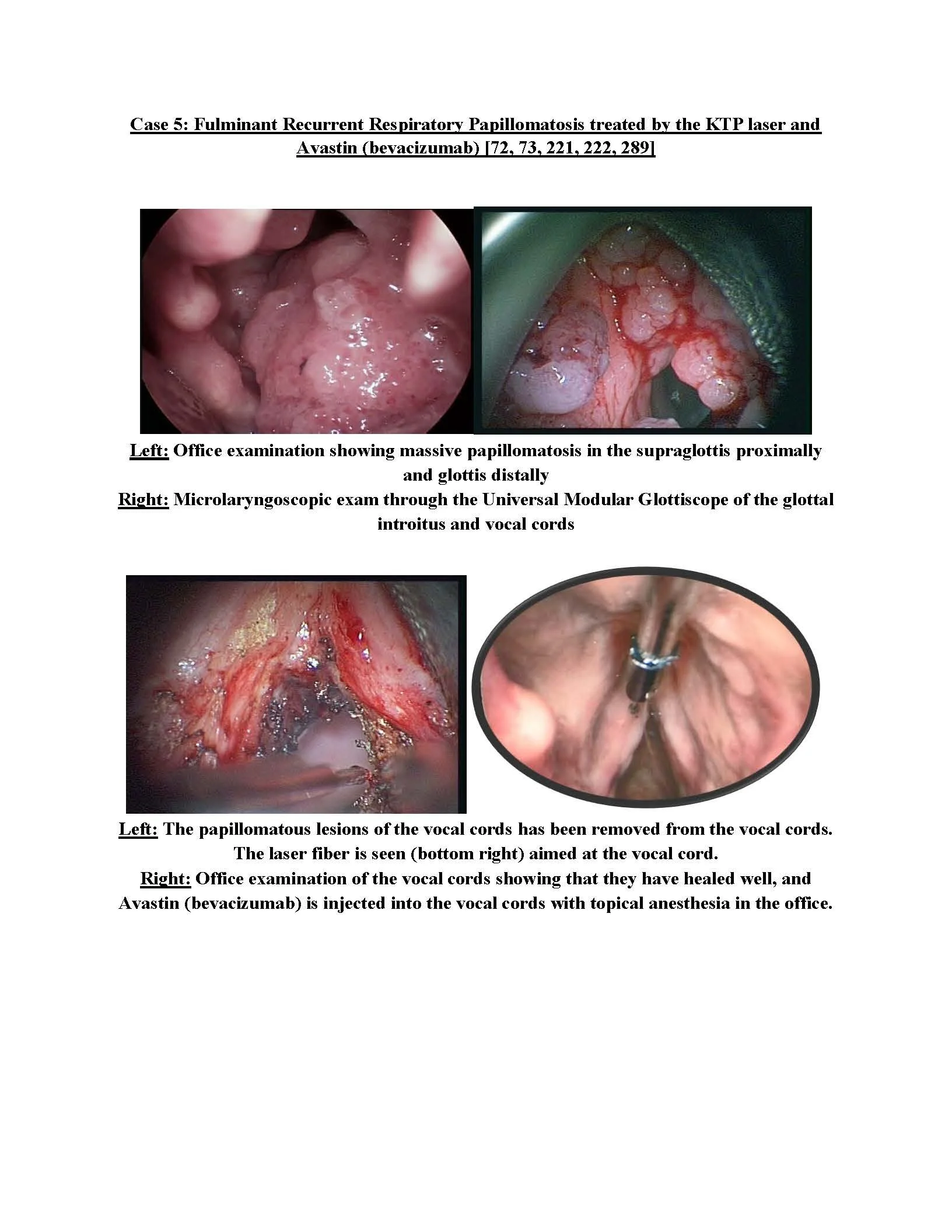 Extensive recurrent respiratory papillomatosis of the larynx and vocal cords