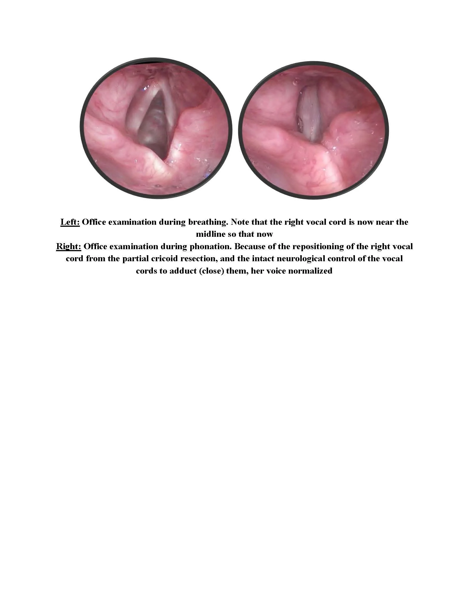 Treatement Results for Glottic Diastasis and Vocal Fold Separation