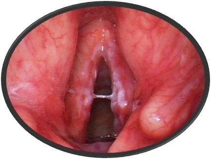 Stage 1 Vocal Cord Cancer