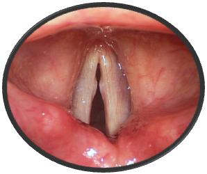 Vocal Cord Nodules in Broadway Performer