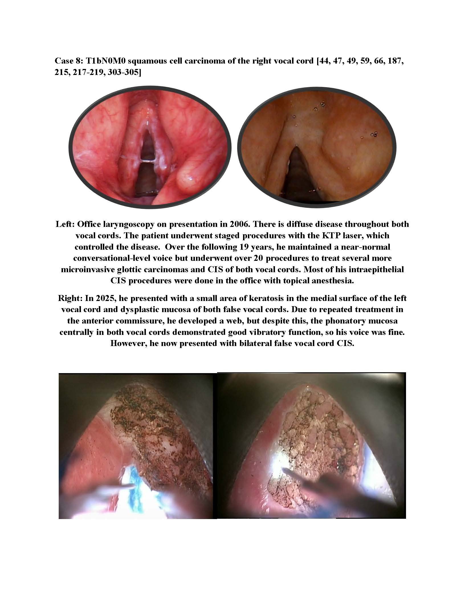 Bilateral Stage I Vocal Cord Cancer