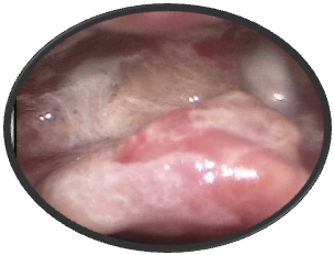 Cancer of the Tongue Base