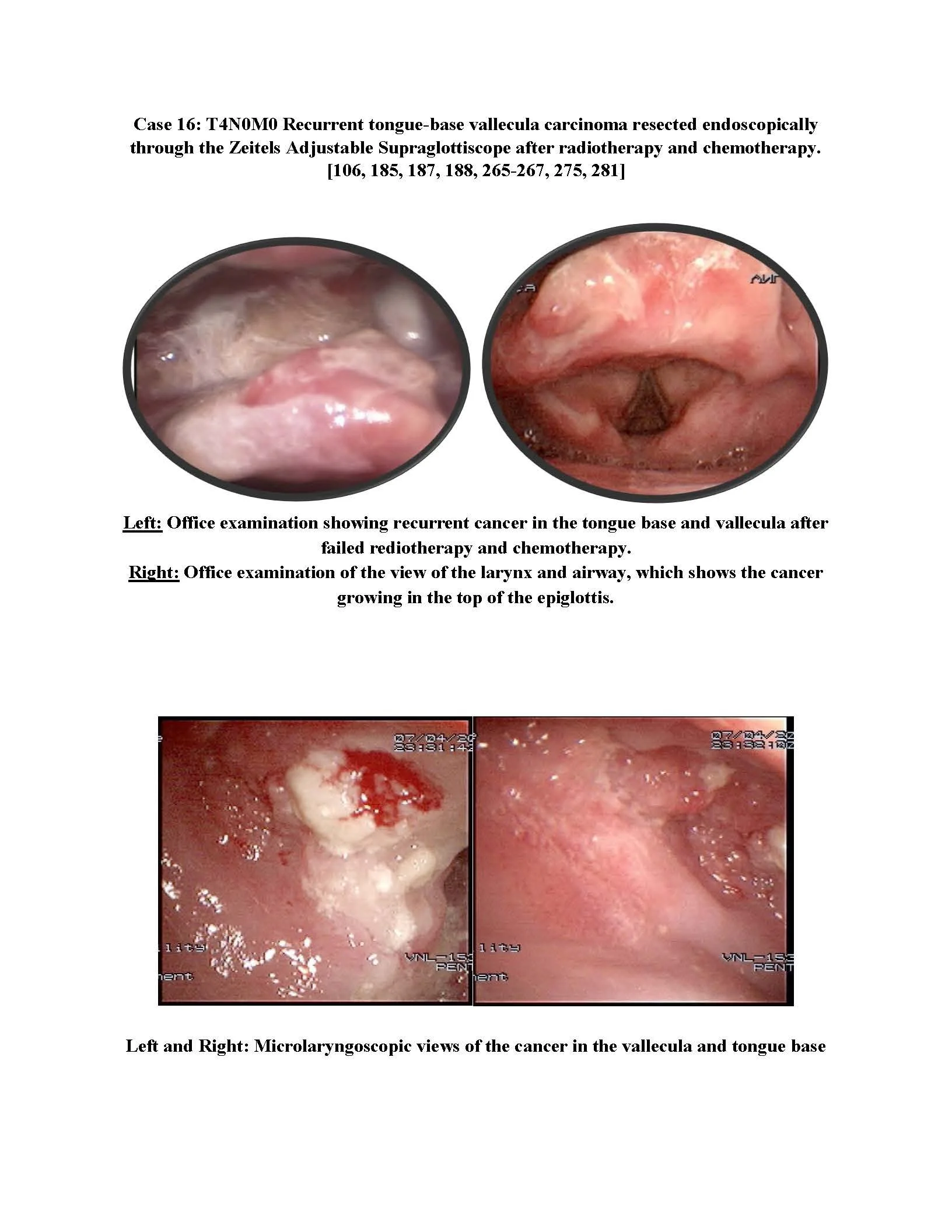 Recurrent tongue-base vallecula carcinoma