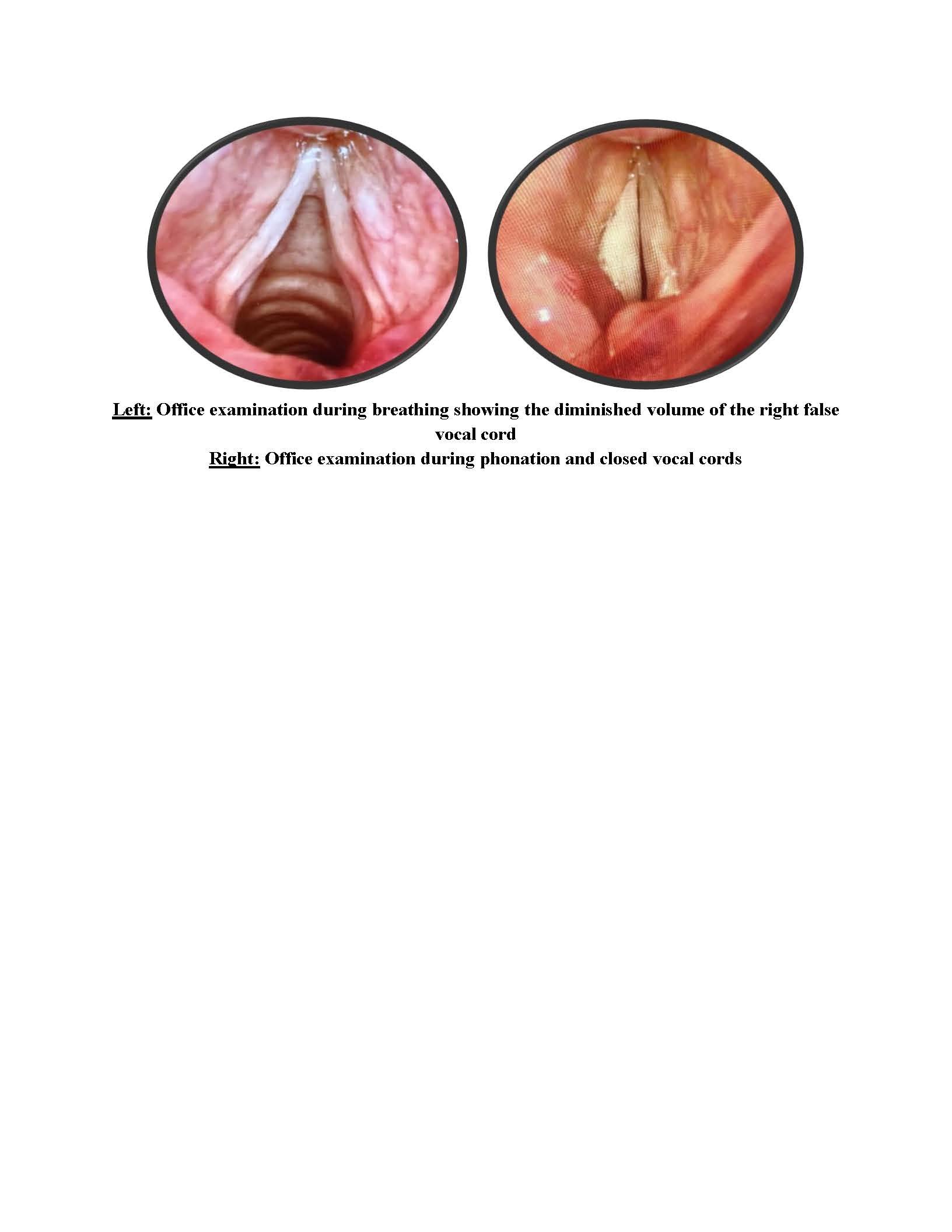 Two close-up images of vocal cords inside the throat, with the left showing a difference during breathing and the right during phonation and closed vocal cords.