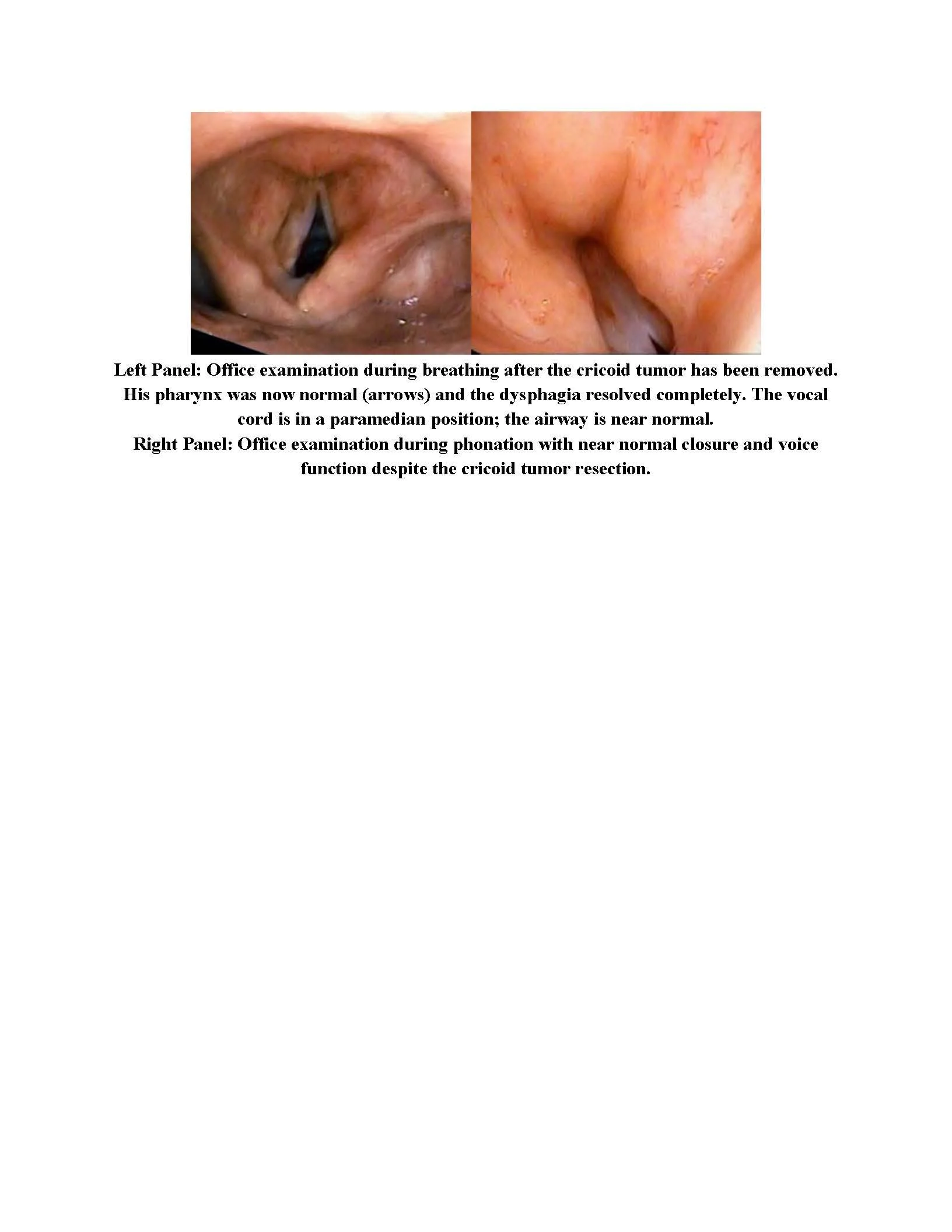 Laryngeal Chondrosarcoma