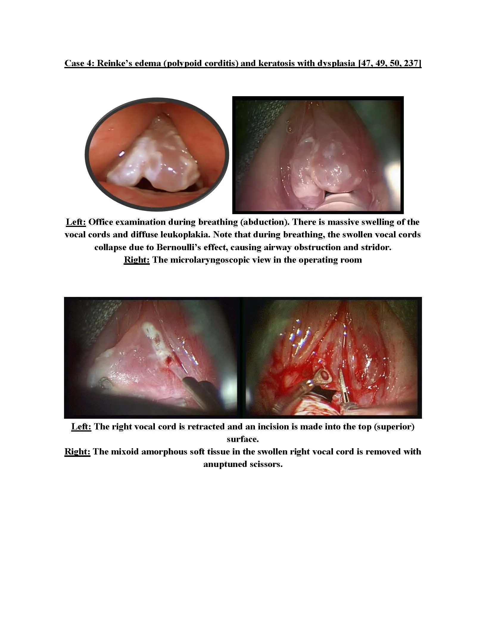 Reinke's Edema (Polypoid Corditis) and keratosis with dysplasia