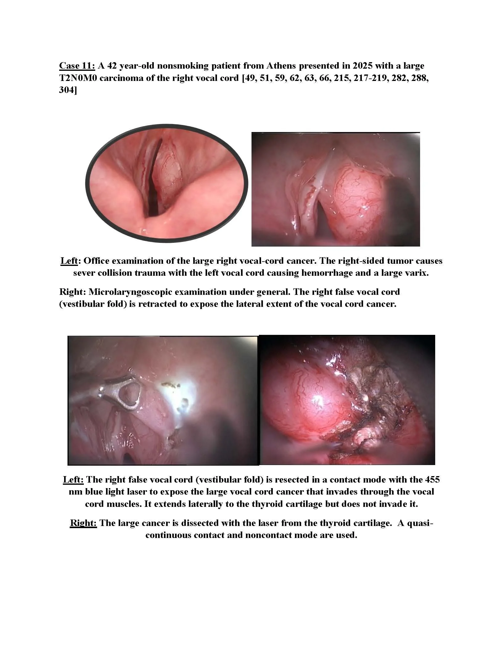 Large Stage 2 Vocal Cord Cancer