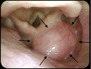 Chondrosarcoma