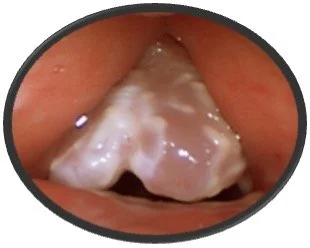 Reinke's Edema (Polypoid Corditis) and Keratosis with Dysplasia