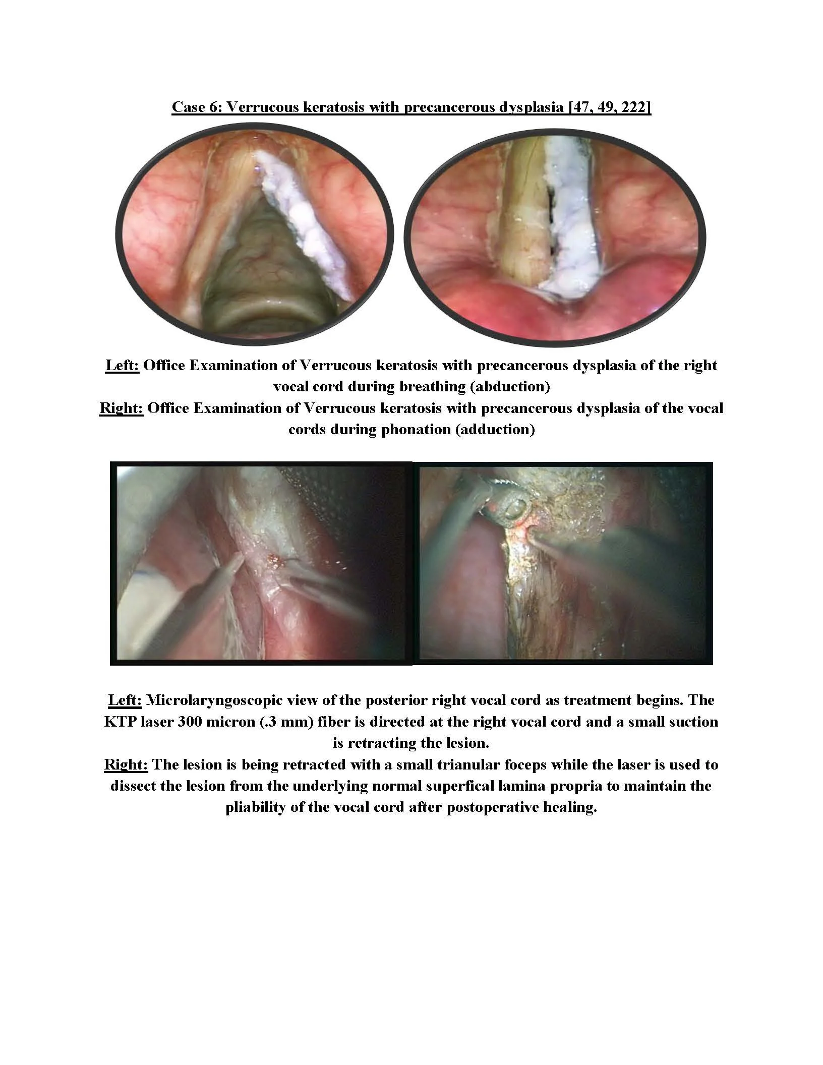 Verrucous Keratosis and precancerous Dysplasia of the vocal cord
