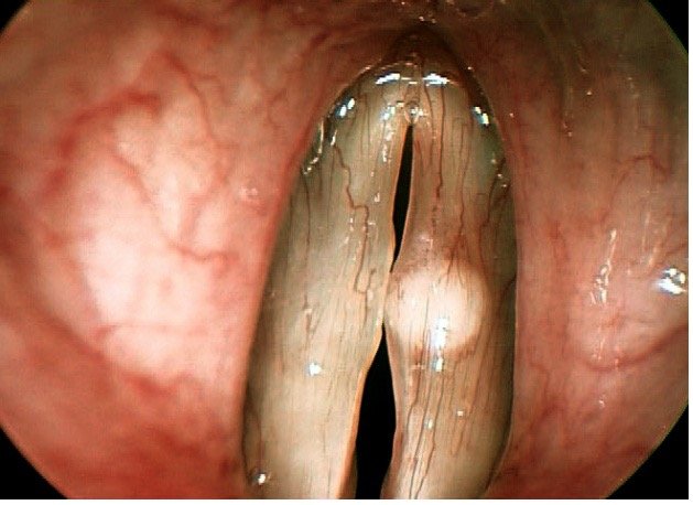 Vocal Cord Mucous Cyst