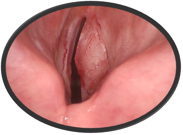 Stage 2 Vocal Cord Cancer