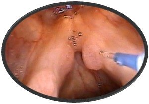 Recurrent Respiratory Papillomatosis (RRP) of the Vocal Cords