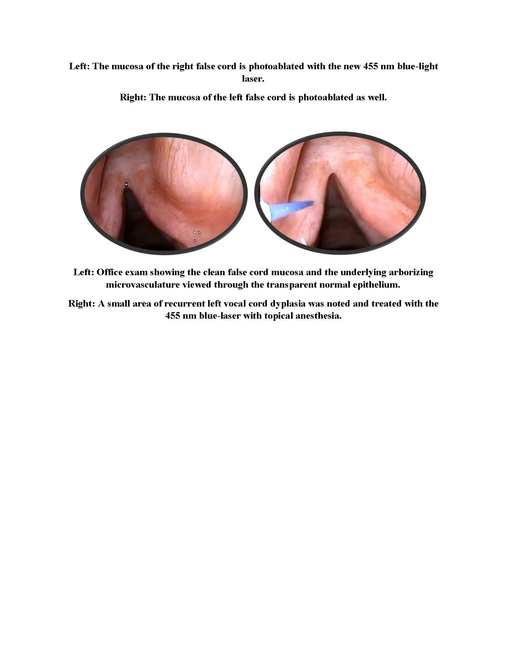 Vocal Cord Cancer and Recurrent Dysplasia Treated with 455 nm blue light VYLO laser