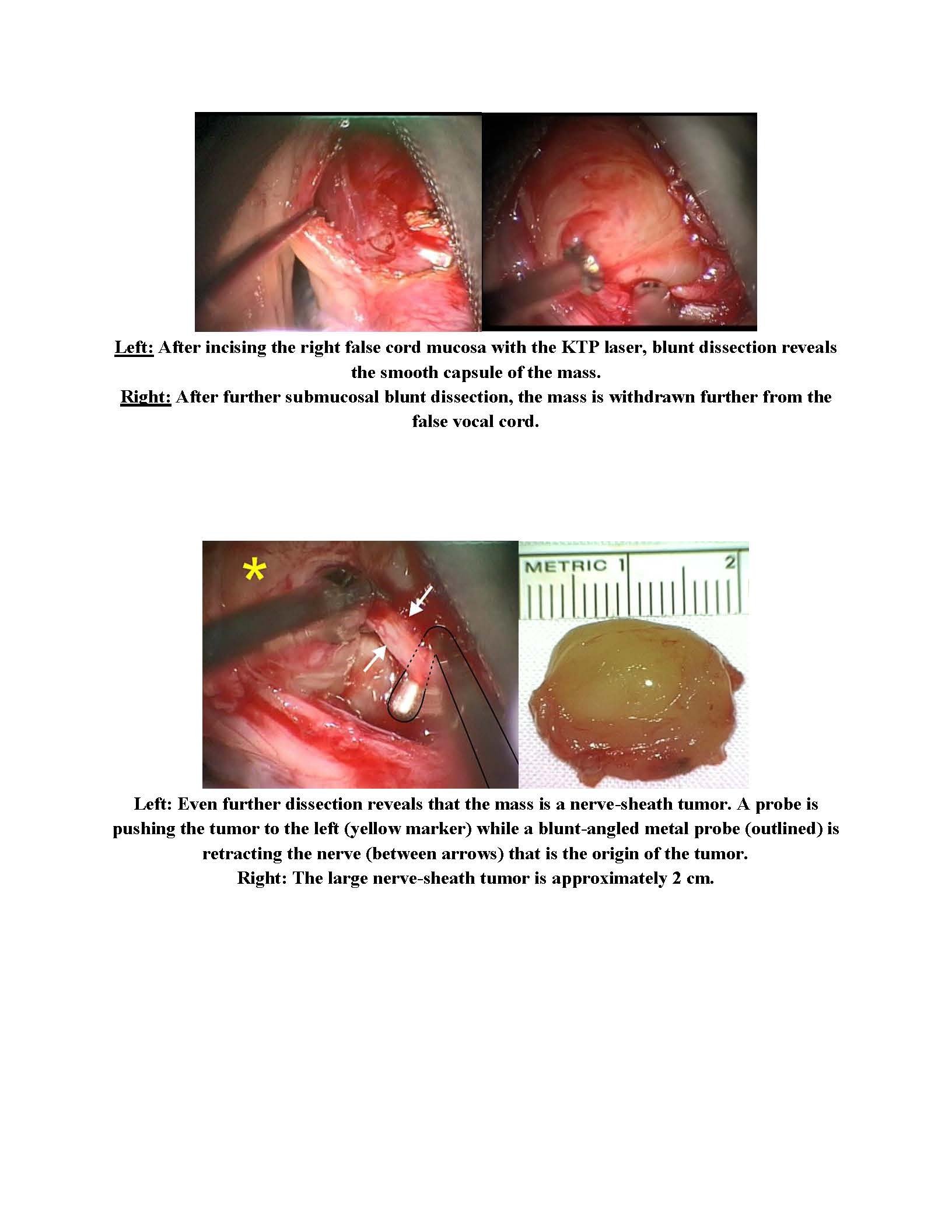 Surgical Treatment for Benign Nerve Sheath Tumor of the Right False Vocal Cord