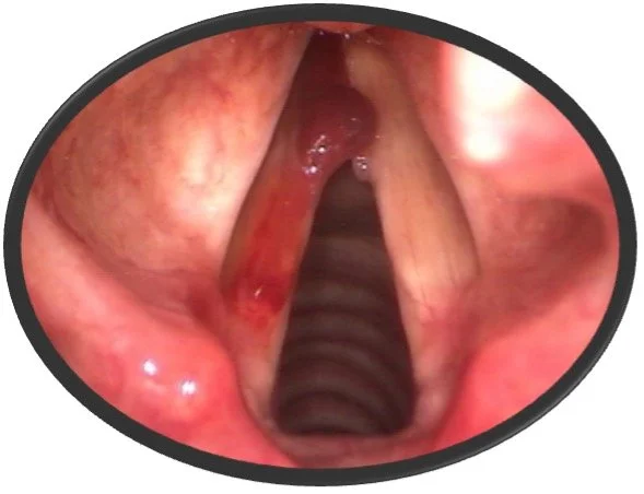 Vocal Cord Bleeding, Hemorrhagic Polyp, Nodules, and Ectasias in a Performer