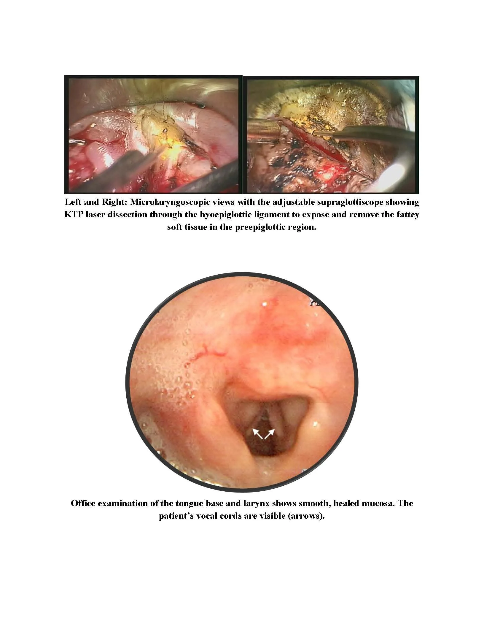 Treatment of Recurrent tongue-base vallecula carcinoma