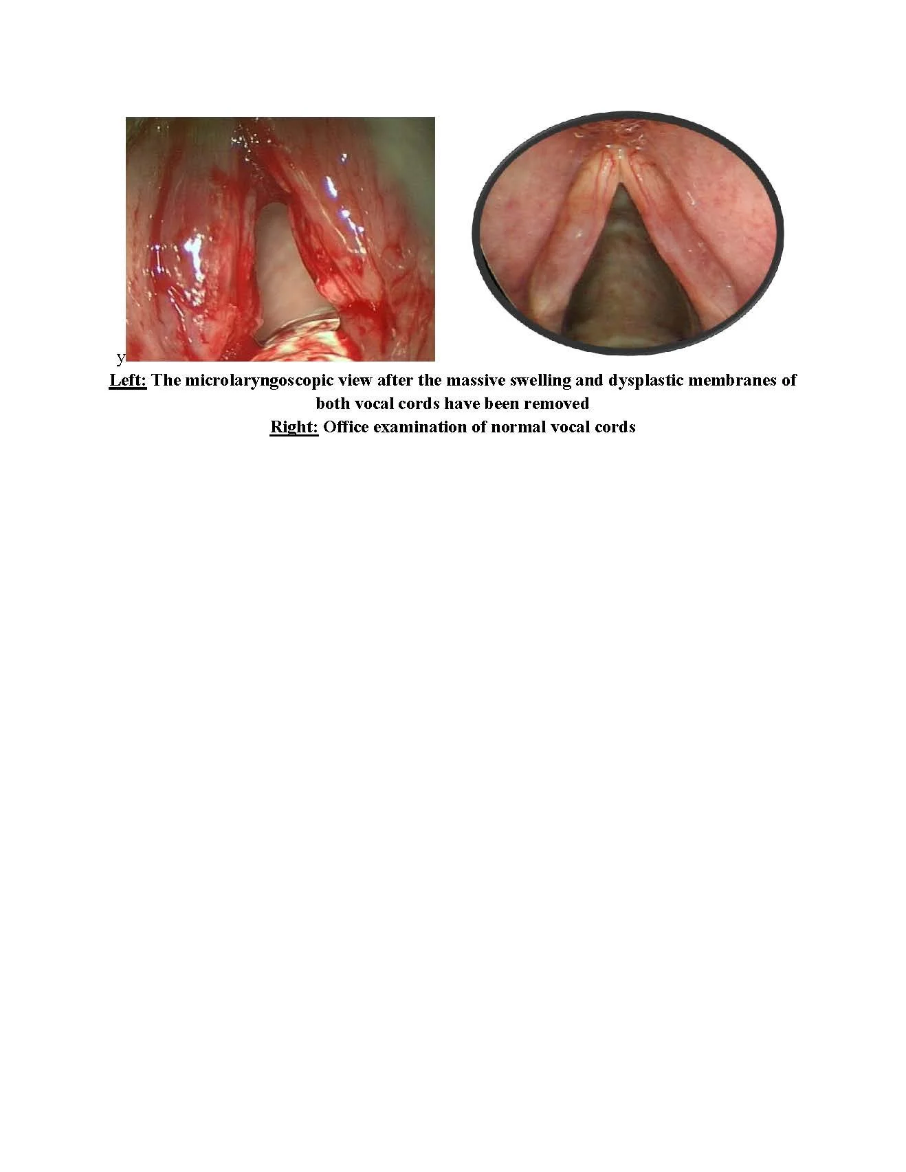 Treatment of Reinke's Edema (polypoid corditis) and keratosis with dysplasia