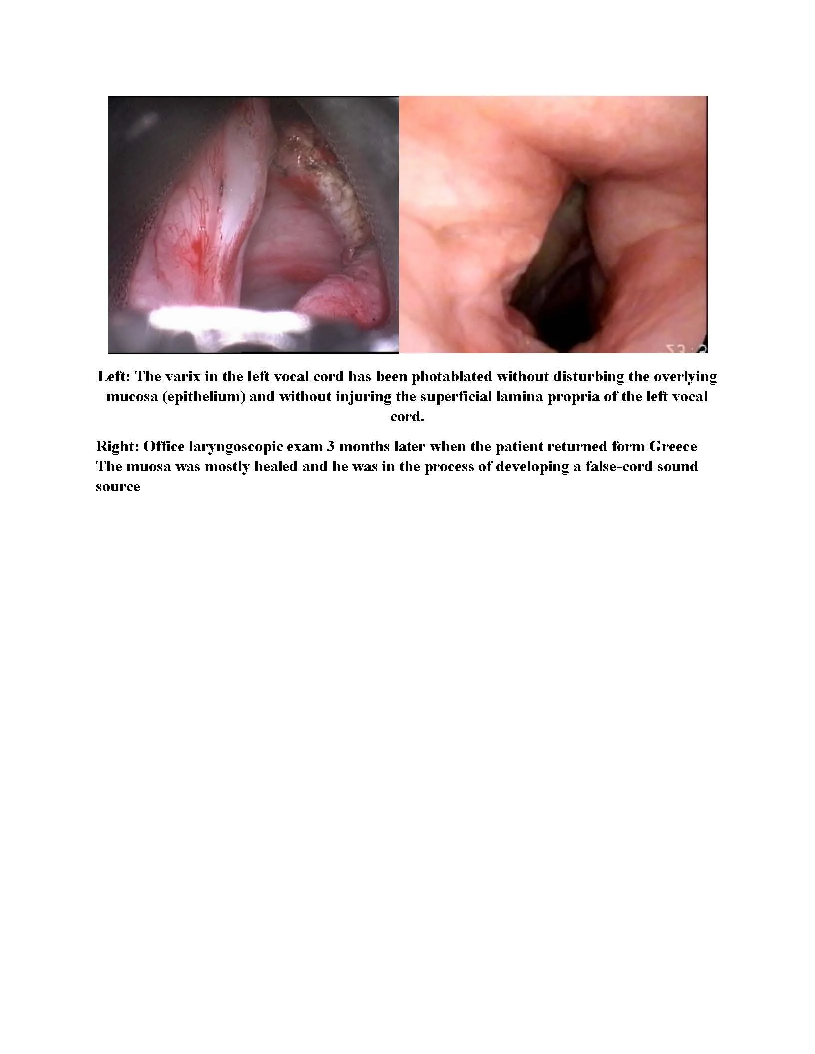 Large Stage 2 Vocal Cord Cancer Treatment