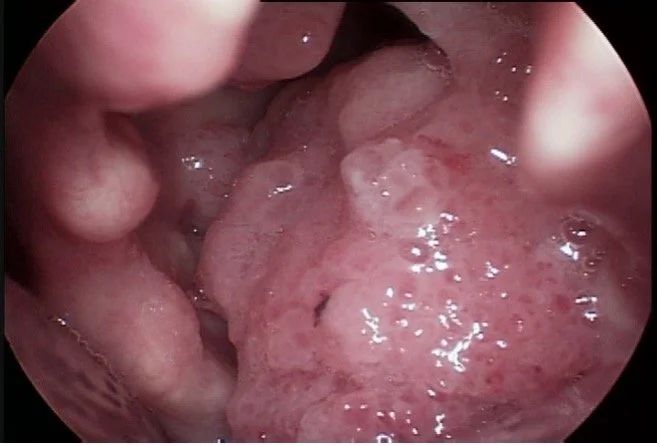 Recurrent Respiratory Papillomatosis (RRP) of the Larynx