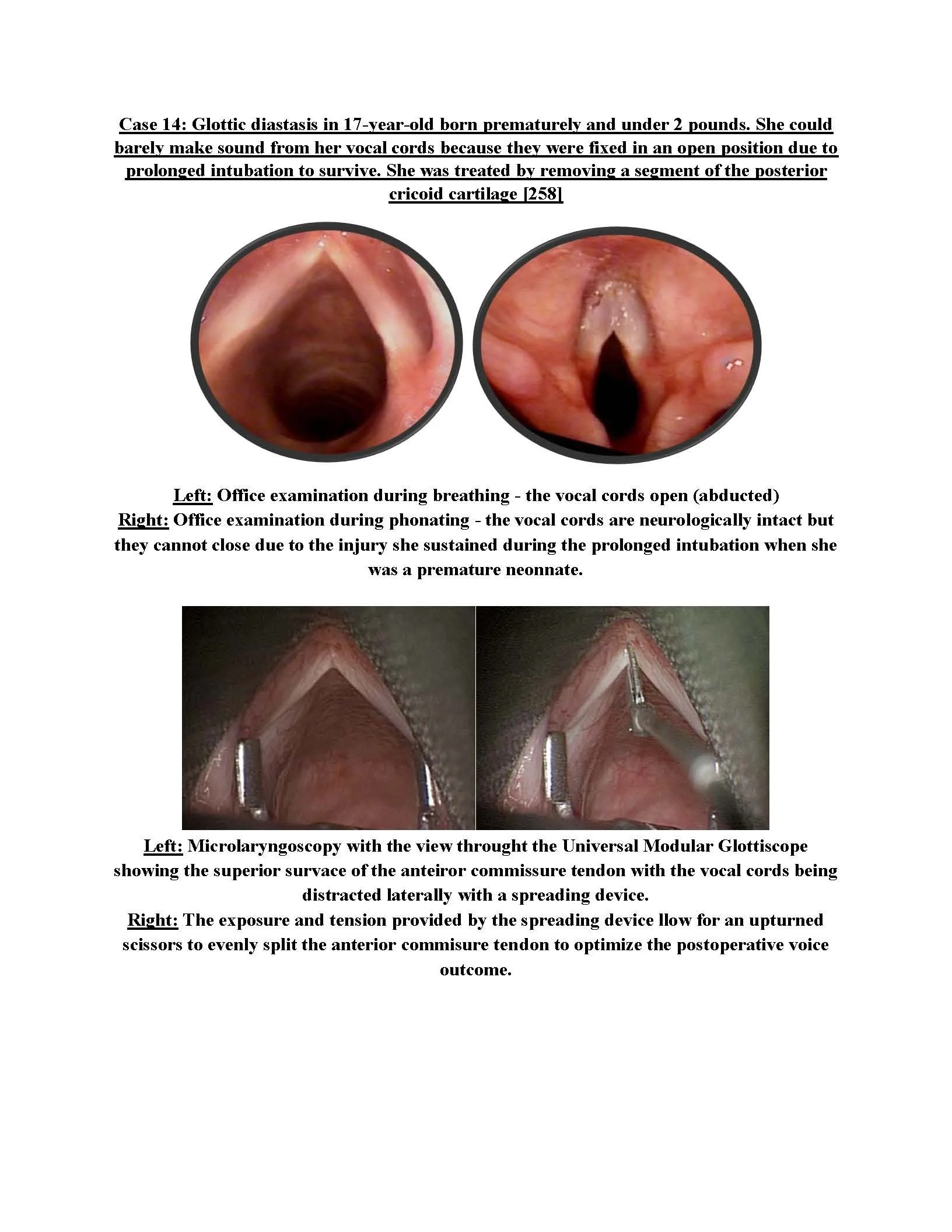 Glottic Diastasis and Vocal Fold Separation
