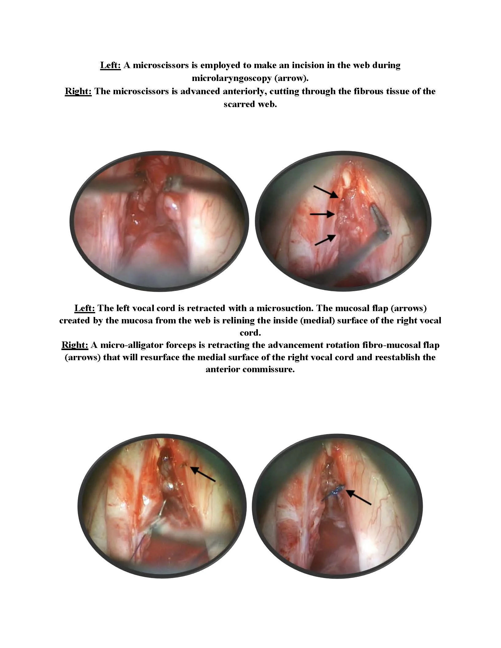 Treatment for Carcinoma in Situ of the Vocal Cords