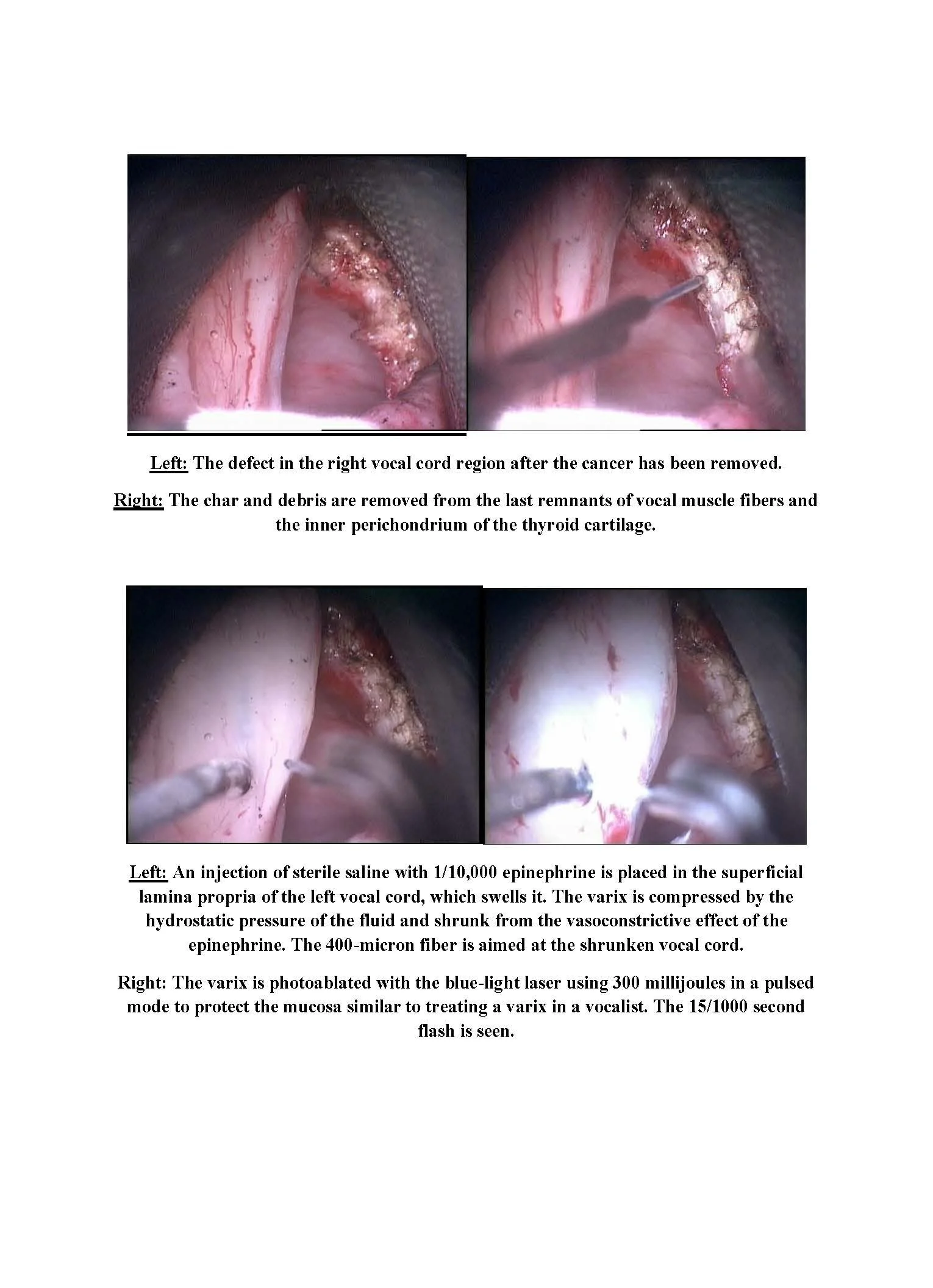 Treatment of Large Stage 2 Vocal Cord Cancer