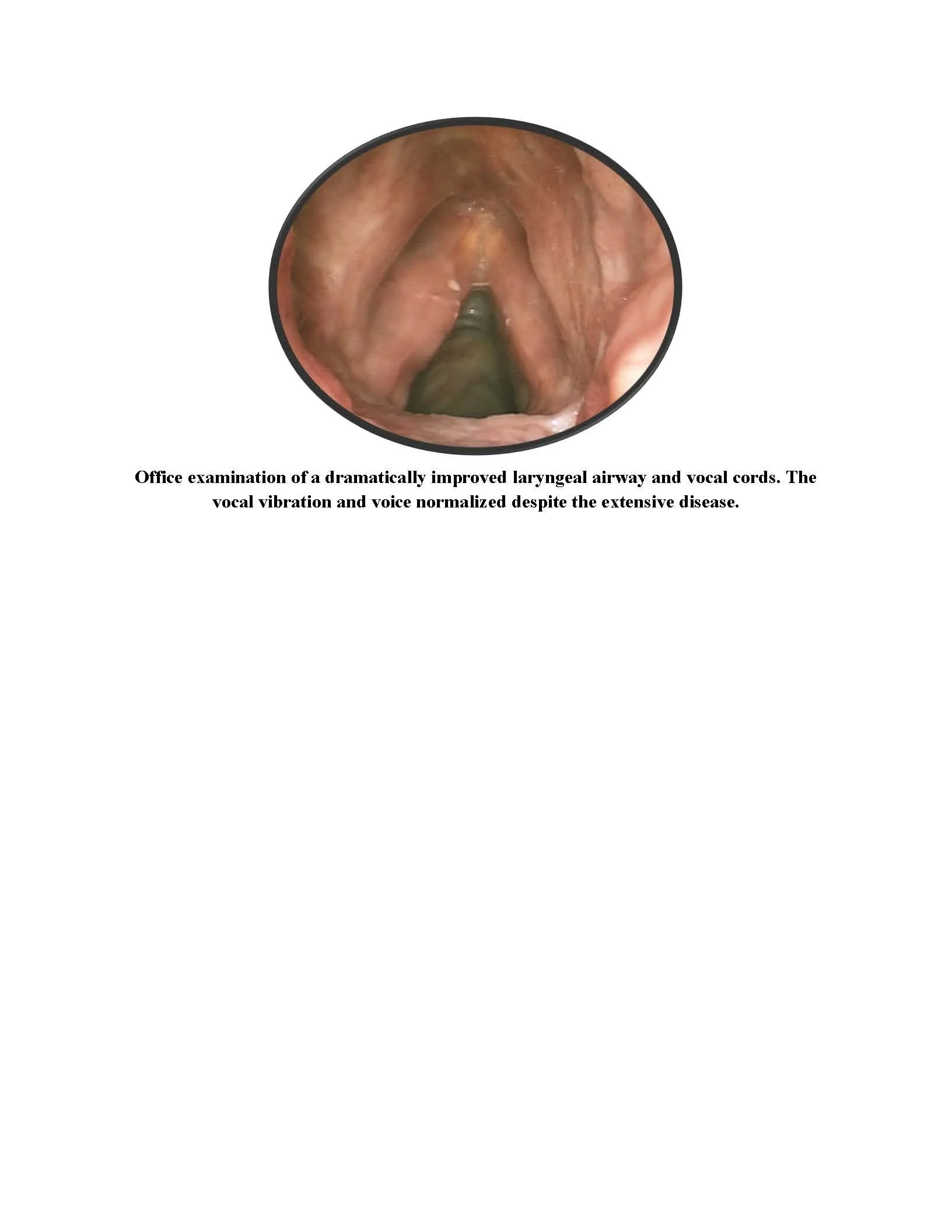 Treatment results for recurrent respiratory papillomatosis following treatment with Avastin (bevacizumab)
