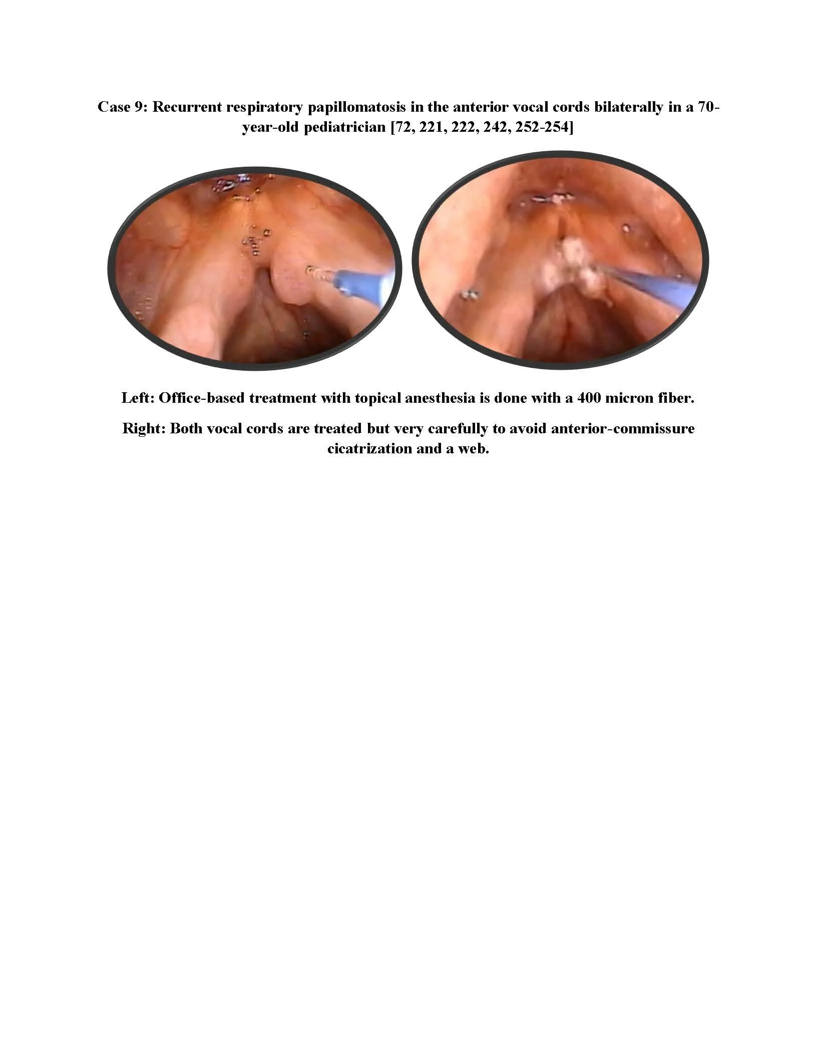 Anterior Recurrent Respiratory Papillomatosis