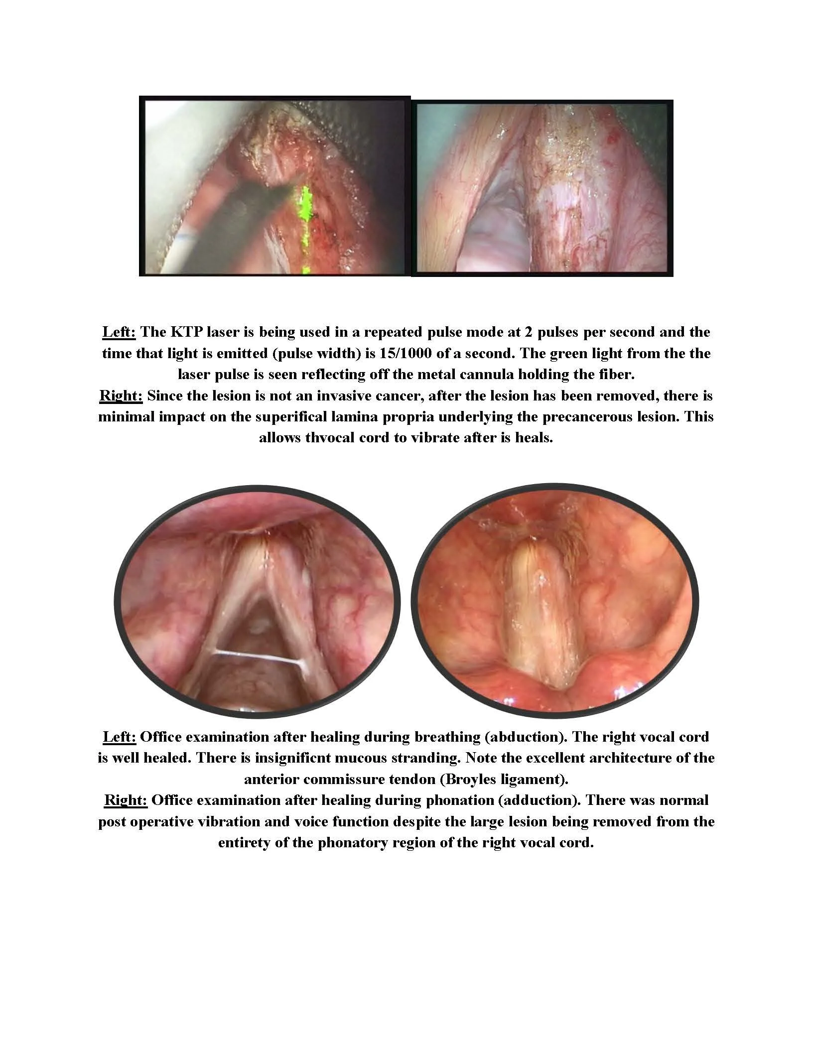 KTP Green Laser Treatment of Vocal Cord Keratosis and Dysplasia