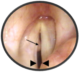 Glottic Stenosis