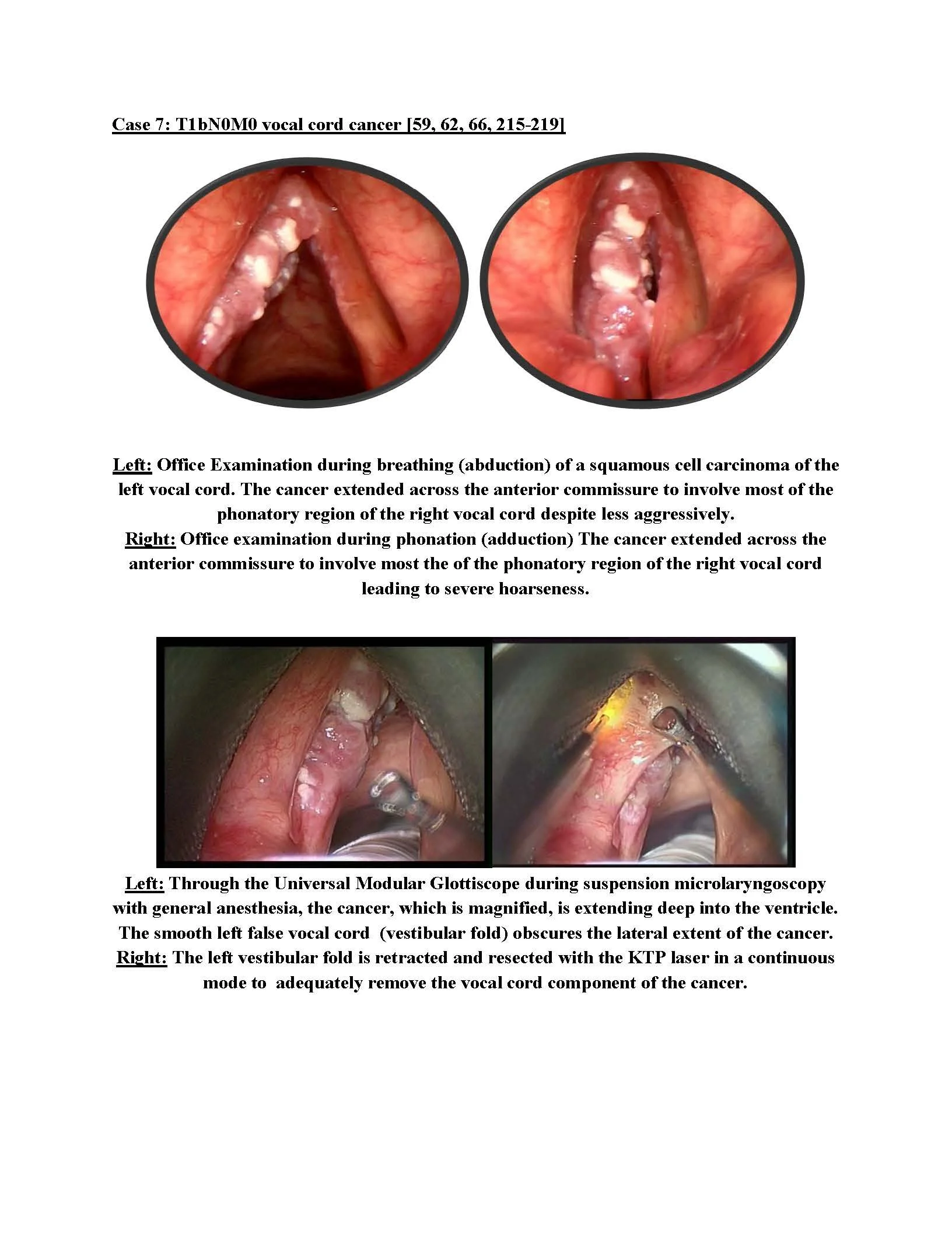 Vocal Cord Cancer Treatment with Voice Preservation