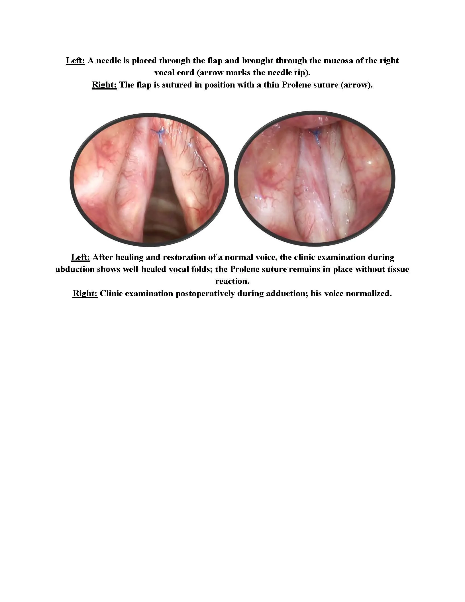 Carcinoma In Situ of the Vocal Cords Treatment