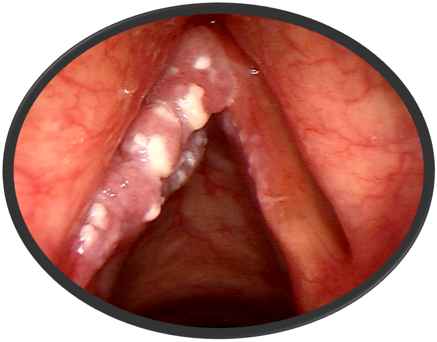 Stage 1 Early vocal cord cancer