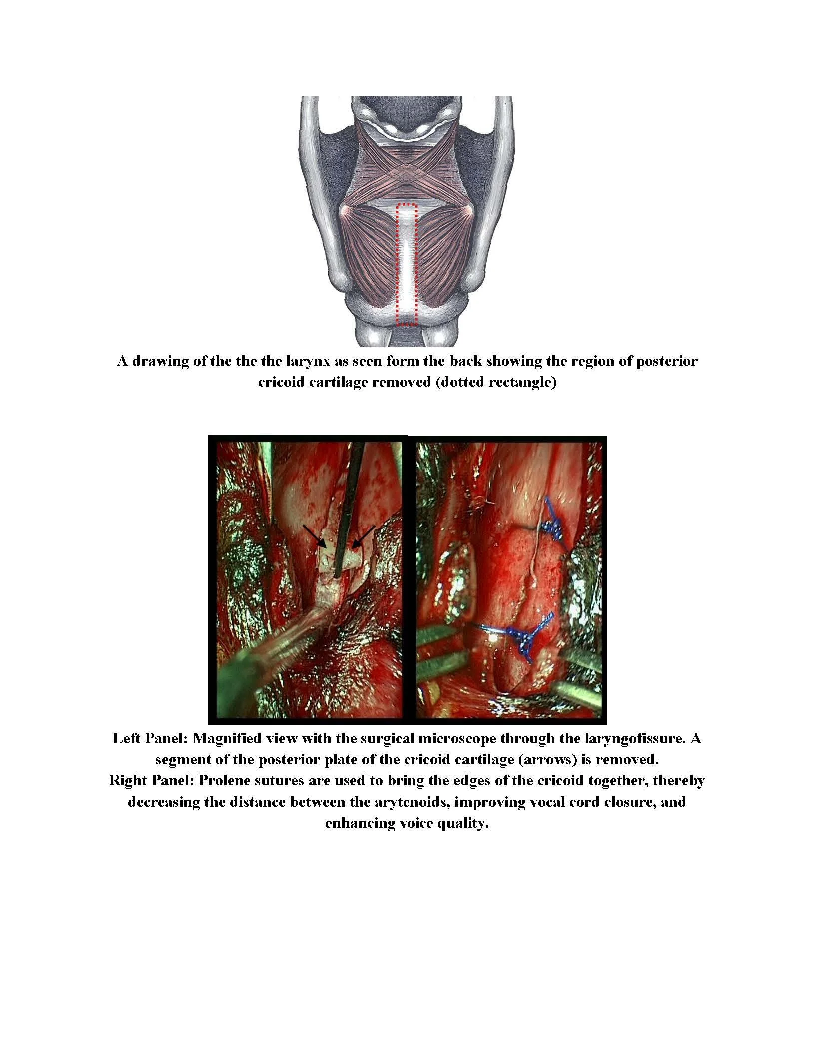 Treatment for Glottic Diastasis and Vocal Fold Separation